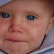 measles-baby-2