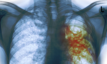 An X-ray of the chest of a man with tuberculosis. The areas infected with TB bacteria are colored red.